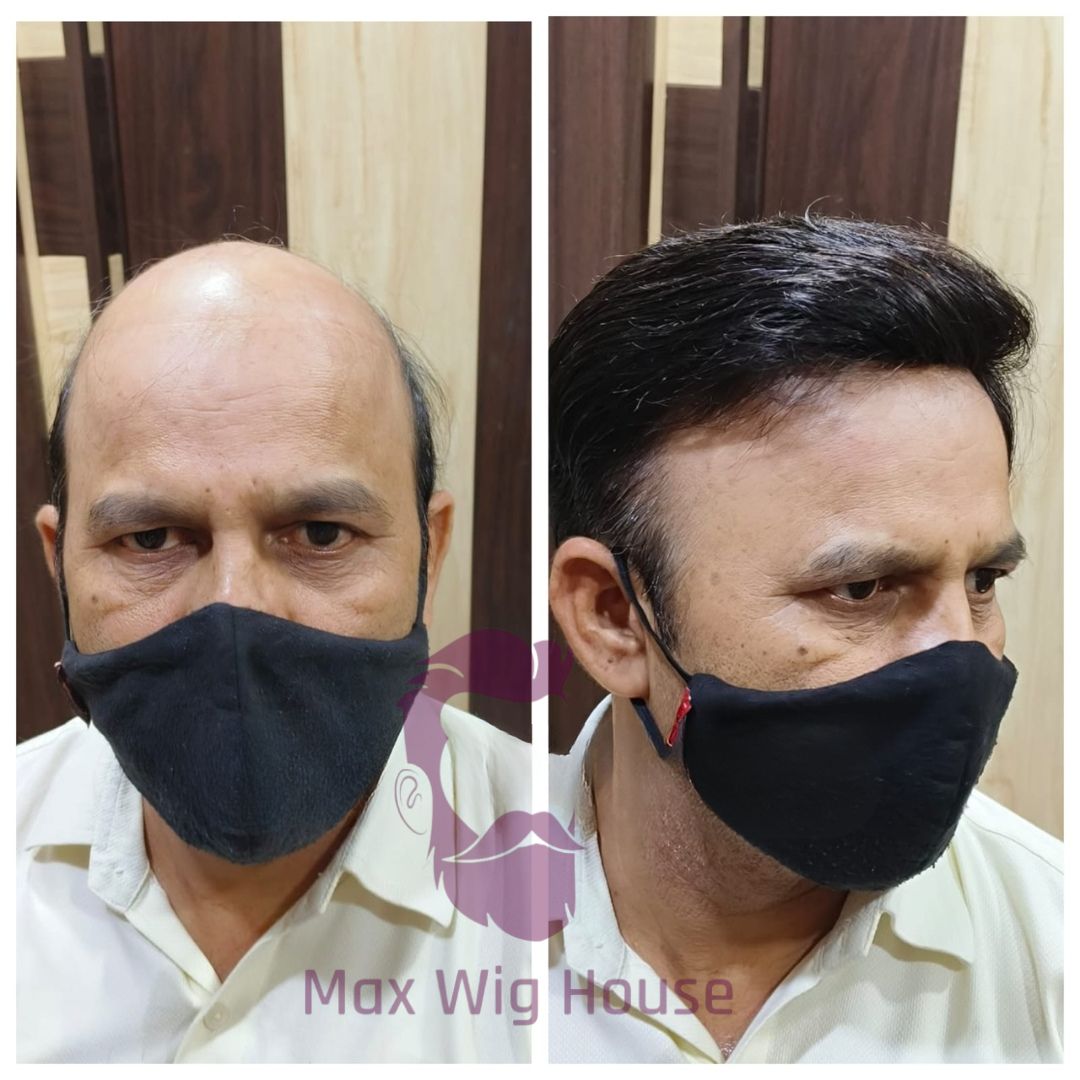 Best Non Surgical Hair Replacement Solution for Men
