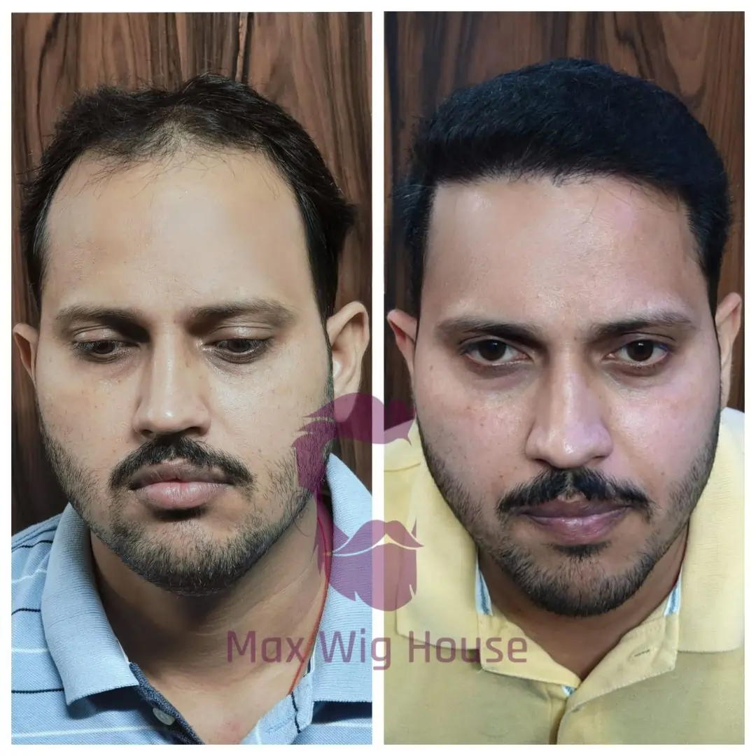 Hair Bonding vs Hair Weaving