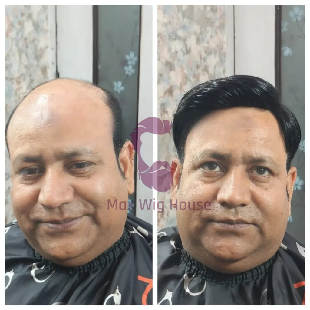 Hair Wig in Uttam Nagar | Get New Look in Just 1 Hour