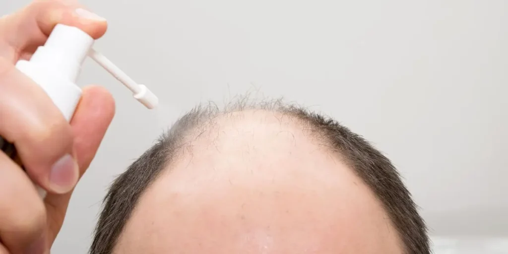 How Hair Patch Solution Gives You a Natural Look Instantly
