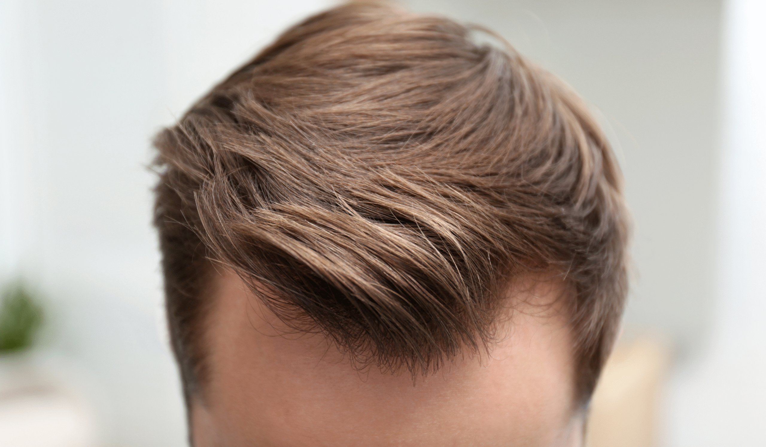 non-surgical hair replacement 